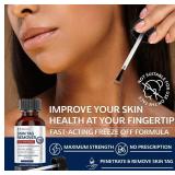 Skin Tag Remover: Skin Tag Remover with Salicylic Acid for Men and Women 30 ML