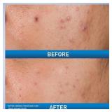 CeraVe Acne Control Gel, 2% Salicylic Acid Treatment With Glycolic Acid + Lactic Acids + Niacniamide, Acne Gel Helps Clear Blemishes Without Over Drying, Alcohol Free & Oil Free, 1.35 Fl Oz