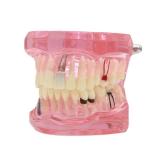 Dentalmall Teeth Model Teeth Typodonts Dental Implant Study Analysis Demonstration Teeth Model number2001 with Restoration Pink