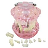 Dentalmall Teeth Model Teeth Typodonts Dental Implant Study Analysis Demonstration Teeth Model number2001 with Restoration Pink