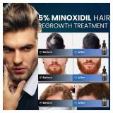 FACTORY SEALED - 5% Minoxidil Hair Growth for Men and Women: Biotin Hair Growth Serum for Beard & Hair Loss, Thinning, and Faster Regrowth Treatment - 60ML
