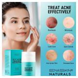 Salicylic Acid Acne Spot Treatment: Cystic Hormonal Pimple Cream for Stubborn Zits, Blemish Breakout & Post-Acne Scars - Face, Body & Back, Teens-Adults, 1.8 oz - Retail: $20