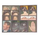 (9) 1910 Medical Skin Disease Stereoscope Cards